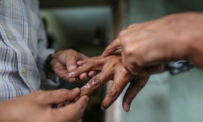 झापामा ६ बालबालिकासहित ६६ जना नयाँ कुष्ठरोगी