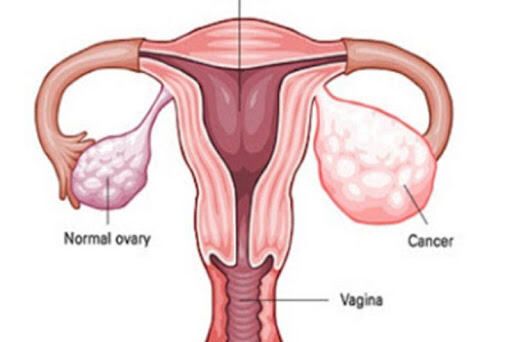पाठेघरको मुखको क्यान्सरः स्क्रिनिङ र खोप विस्तार जरुरी