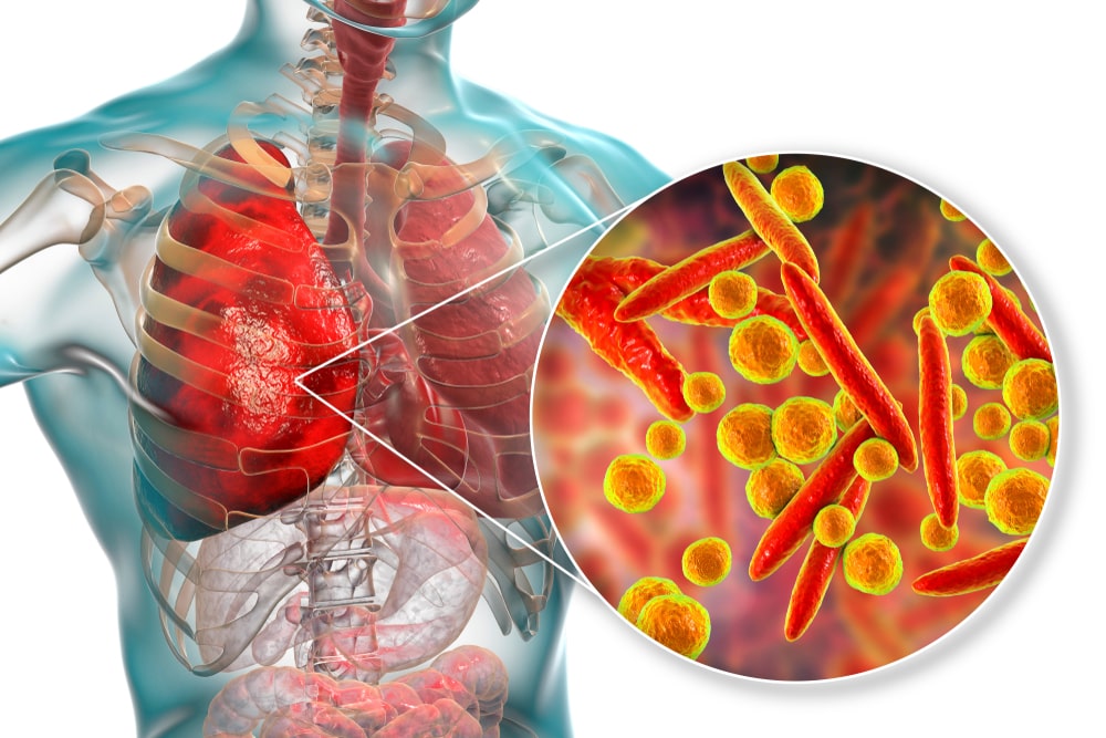 बढ्दै निमोनियाका बिरामी : जाडोमा कसरी बच्ने ?