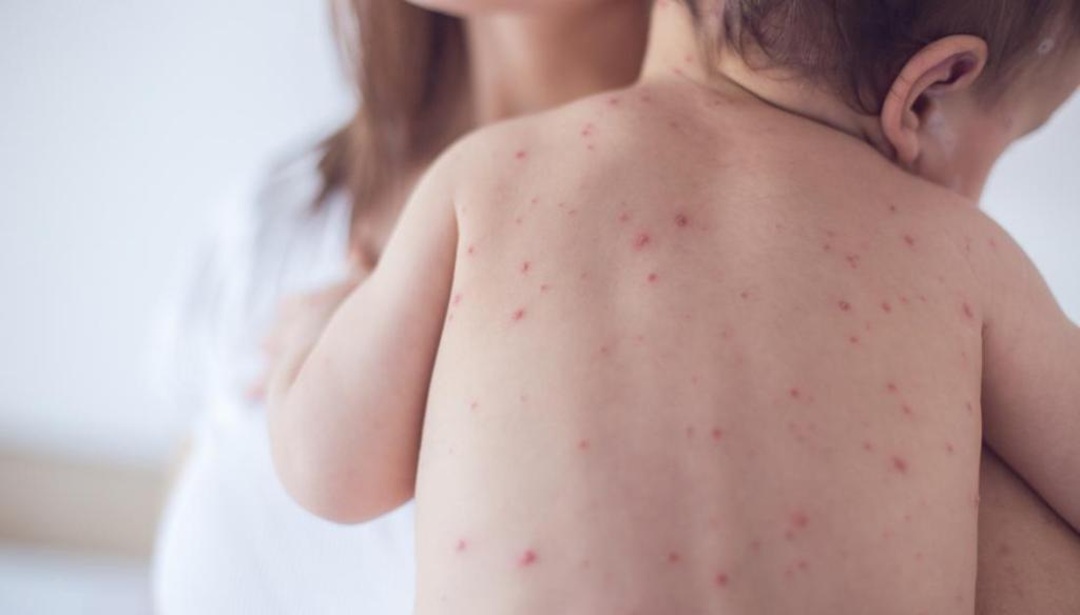 बागलुङमा दादुरा नियन्त्रणत प्रभावकारी