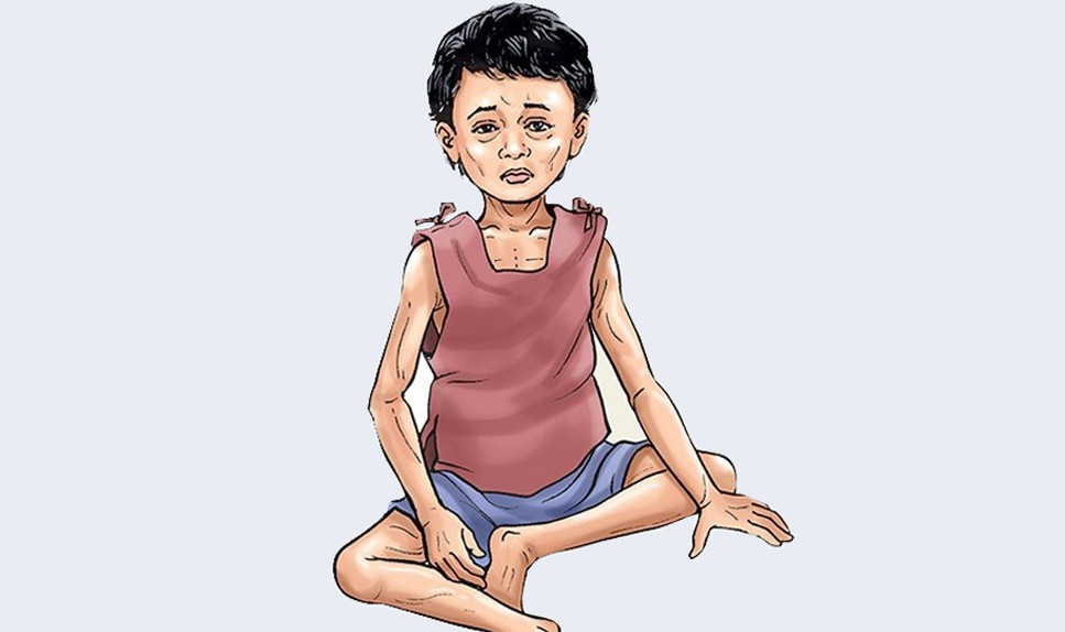 अठार हजार बालबालिकामा शीघ्र कडा कुपोषण